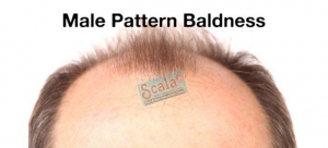  Baldness Cure in Hyderabad,Hair Fall Treatments in Hyderaba